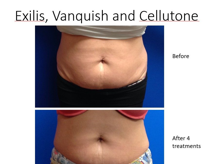 Fat reduction for Charlotte, NC patient’s stubborn areas