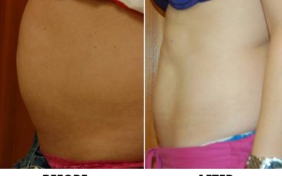 Vanquish: a cosmetic procedure for fat reduction in Charlotte, NC