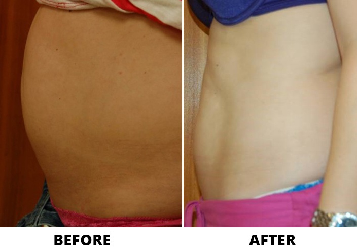 Vanquish: a cosmetic procedure for fat reduction in Charlotte, NC